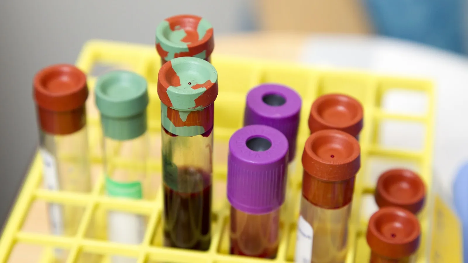 Gamma-GT too high: what this liver value does and does not say about alcohol